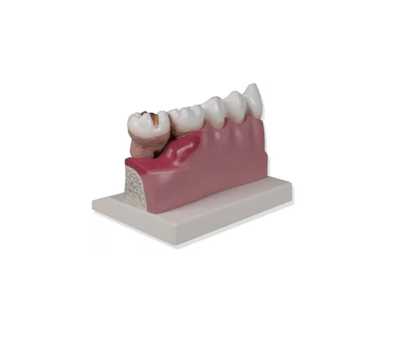 Dentalmodell, 4 - fache Größe - Erler - Zimmer