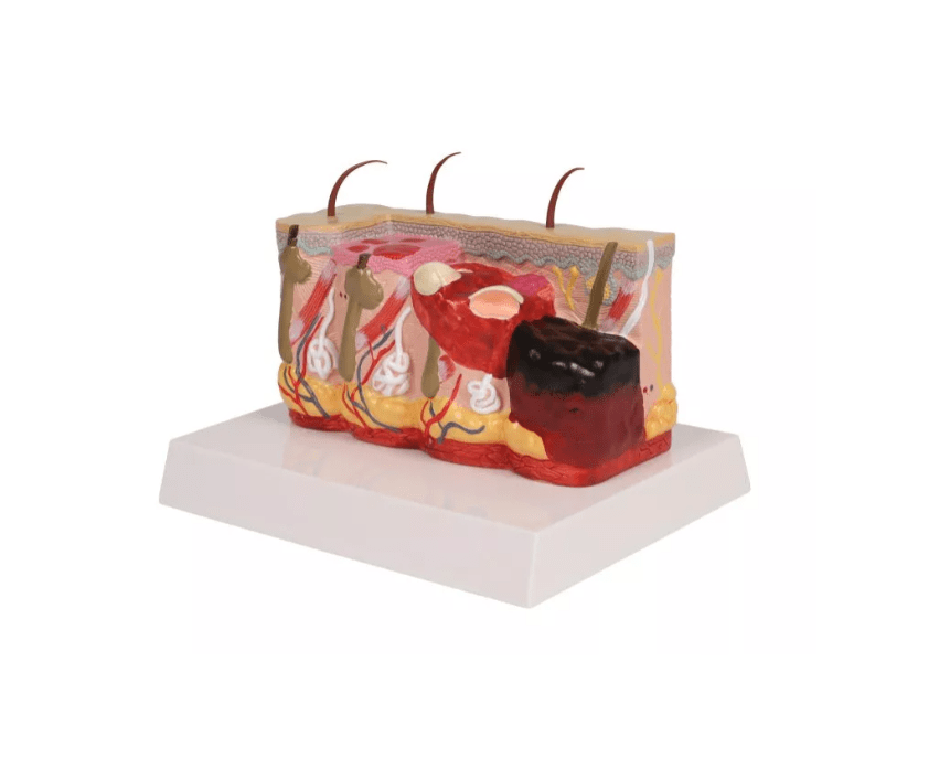 Pathologisches Hautmodel mit Verbrennung, 30 - fache Größe - Erler - Zimmer