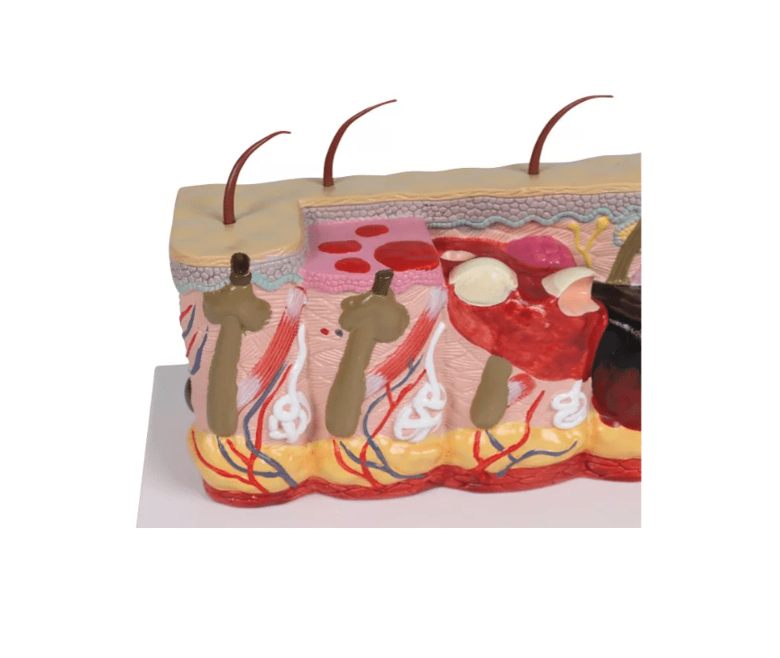 Pathologisches Hautmodel mit Verbrennung, 30 - fache Größe - Erler - Zimmer