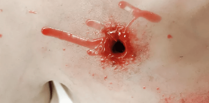 Erler-ZimmerTrauma Training TorsoDocMed GmbH