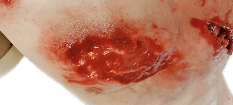 Erler-ZimmerTrauma Training TorsoDocMed GmbH